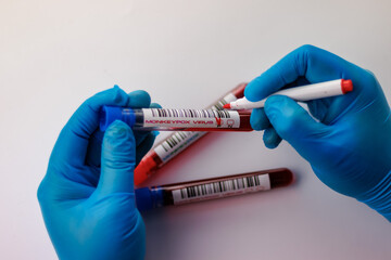 flasks with blood tests for monkey pox virus positive and negative