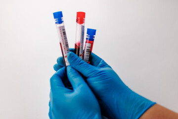 flasks with blood tests for monkey pox virus positive and negative