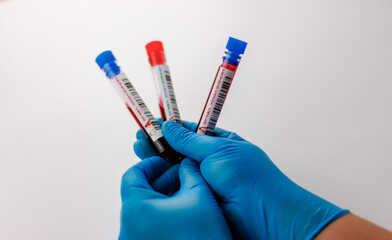 flasks with blood tests for monkey pox virus positive and negative