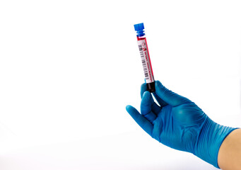 flasks with blood tests for monkey pox virus positive and negative