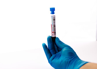 flasks with blood tests for monkey pox virus positive and negative