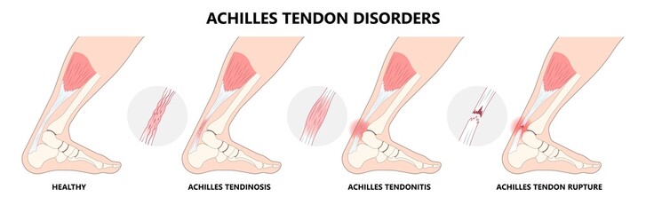 Small tear of Achilles tendon injury Feet calf test range of motion slight ache problem limb Thompson Simmonds and torn Rupture - obrazy, fototapety, plakaty