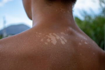Handsome guy got sunburn and got tan lines on his back. The skin sloughs off it is burn skin. It...