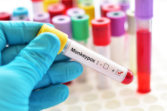 Blood sample tube positive with Monkeypox virus, new epidemic disease in 2022