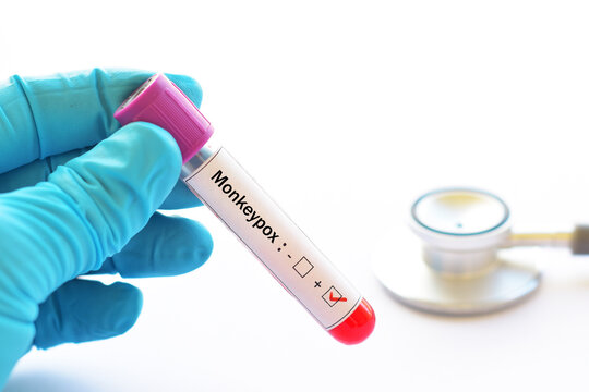 Blood sample tube positive with Monkeypox virus, new epidemic disease in 2022