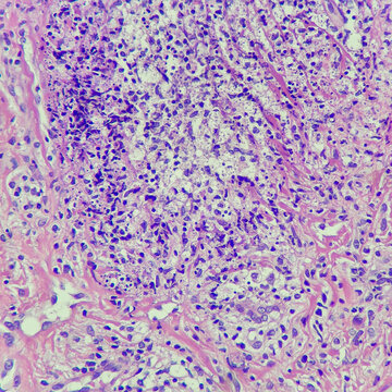 Camera photo of dermal chronic inflammation with yeast-formed organisms, suspicious for penicillosis, magnification 400x, photograph through a microscope
