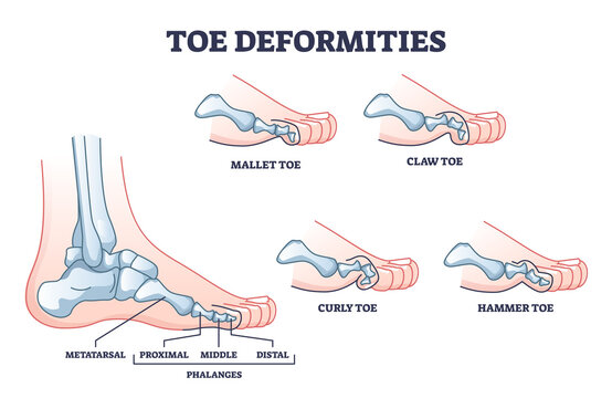 Toe deformities and foot phalanges bone defects outline diagram. Labeled educational scheme with proximal, middle and distal skeleton and mallet, claw, curly or hammer examples vector illustration.
