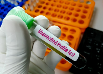 Rheumatoid Profile testing for rheumatoid arthritis diagnosis a disease of joint inflammation.