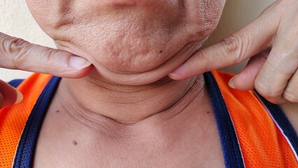 person showing the fingers touching the flabbiness adipose hanging skin under the neck, problem...