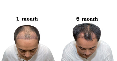 Hair transplantation surgery steps. Patient before and after the procedure. Male hair loss...