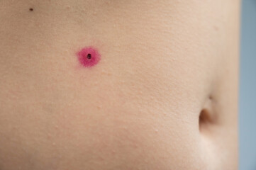 Close-up of a removed wart on a woman's abdomen. Human papillomavirus after burning.