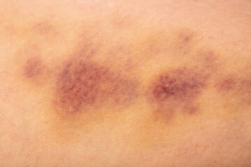 Fototapeta premium Bruises on the human body. Severe bruise from impact, bruising and hematoma.