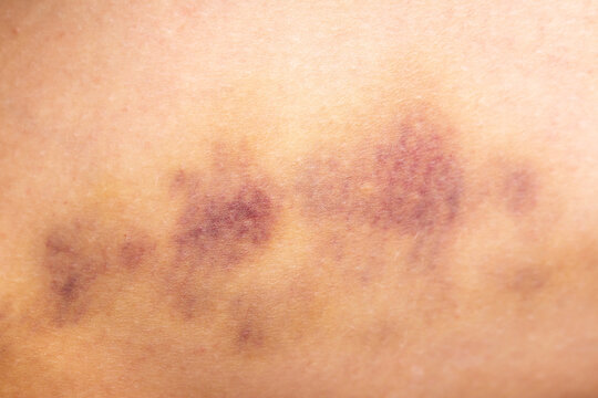 Bruises on the human body. Severe bruise from impact, bruising and hematoma.