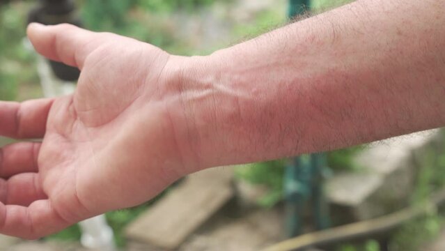 Irritation and red spots on the skin of the hands.