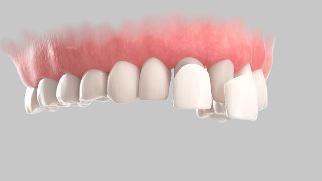 3d animation of placement dental veneers over central incisors