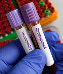 Blood sample for Chromogranin A and B Test. to secreting neuro-endocrine tumour or multiple...