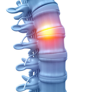 Lumbar intervertebral spine hernia. 3d illustration