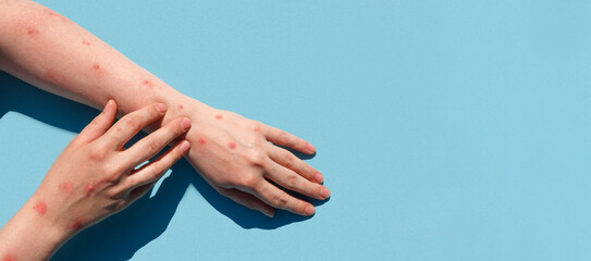 Monkeypox new disease dangerous over the world. Patient with Monkey Pox. Painful rash, red spots blisters on the hand. Close up rash, human hands with Health problem. Banner, copy space