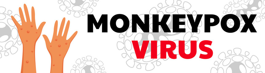 Fototapeta premium Monkeypox virus poster. Web banner of monkey pox skin infection of person. Vector Illustration.