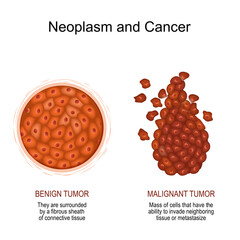 Neoplasm and Cancer. malignant and benign tumor.