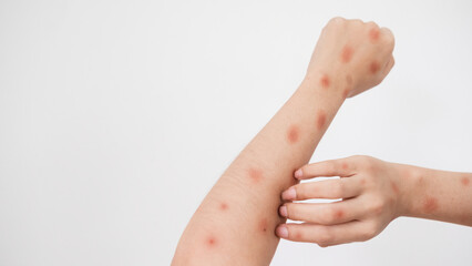 Concept of epidemic of monkey pox virus, white woman scratching skin, red rash, pustules and abscess, itching after being infected with monkeypox virus.