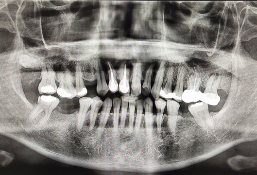 panoramic radiograph skull full mouth x-ray human disease oral surgery dentistry teeth patient care. CT scan of the jaw orthopantomogram root tooth film X-ray dental pin. Science healthy tooth concept
