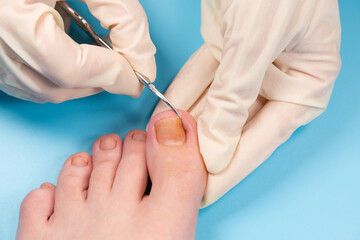 doctor cuts the injured toenail. Hands in rubber gloves touch injured toenail in clinic. Diagnosis, treatment of mycosis of feet. Podiatrist treating ingrown toenail. Inflammation of the toes - 508944231