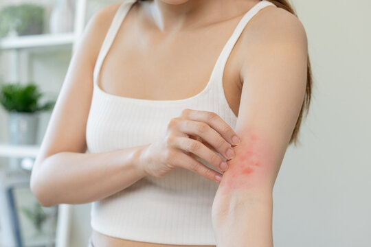 Dermatology asian young woman, girl allergy, allergic reaction from atopic, insect bites on her arm, hand in scratching itchy, itch red spot or rash of skin. Healthcare, treatment of beauty.