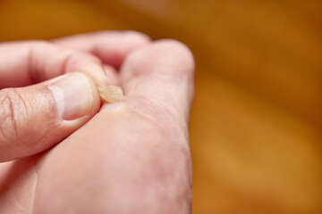 A piece of calluses on the leg.