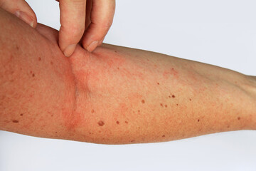 Eine Frau hat einen juckenden roten Hautausschlag am Arm
