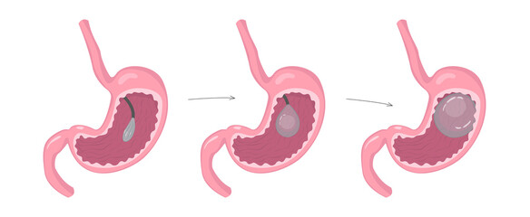 Installation of a gastric balloon into stomach. Methods of weight loss surgery. Bariatry. Human anatomy illustration for infographics, atlas, textbook or study material. - obrazy, fototapety, plakaty