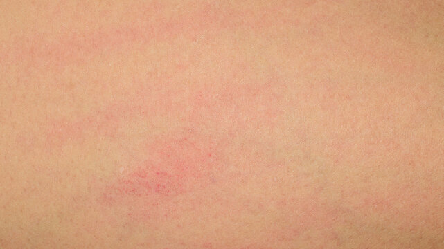 Red Rash On Human Skin