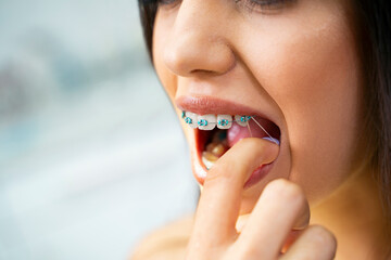 Young girl putting elastics bands over dental brackets 