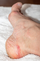 Foot with callus on a white towel, close-up. Red sore on leg from wearing shoes. Bloody callus on the heel. Dry skin on the feet