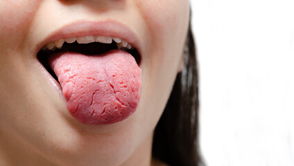 Tongue of a young Caucasian woman with benign migratory glossitis. Tongue with candidiasis. Cracks...