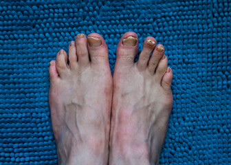 Onychomycosis with fungal nail infection two feet.

