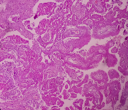 Intra-cranial Space Occupying Lesion(biopsy): Brain Cancer, Metastatic Papillary Adenocarcinoma, Papillary Meningioma, Show Brain Tissue, Necrosis Present. Malignant Tumor.