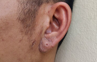 Portrait showing the earlobe inflammation of the patient man.