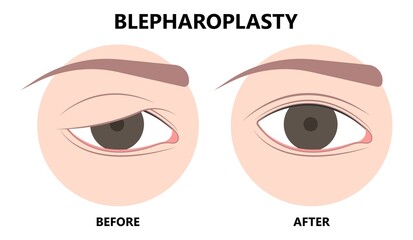 Before and after of drooping eyelid lift surgery or blepharoplasty surgical procedure to treat removes excess skin