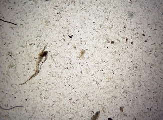 Microscopic urine examination showing Hyaline cast with plenty pus cell and plenty RBC