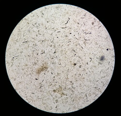 Microscopic urine examination showing Hyaline cast with plenty pus cell and plenty RBC