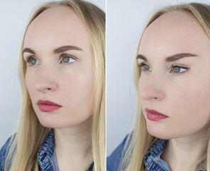 Fox eye lift. Before and after. On left is a girl with normal eyes, and on right is after an...