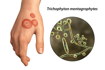 Hand fungal infection, tinea manuum, 3D illustration © Dr_Microbe