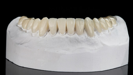 dental model with a set of ceramic veneers of the lower jaw on a black background