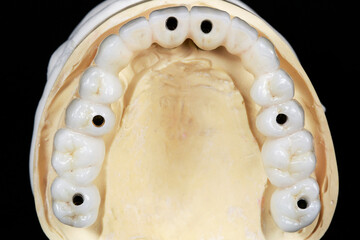 ceramic dental prosthesis with tooth morphology on a plaster model top view on a black background