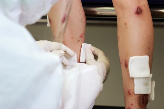 A Nurse Wearing Medical Gloves Dressing Wound Of Multiple Discrete Well Defined Scaly Erythematous Pustules And Plauques With Crusted And Serum Oozing At Both Legs With Sterile Gauze. Chicken Pox.