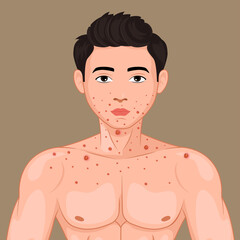 Male face affected by blistering rash because of Monkeypox or other viral infection