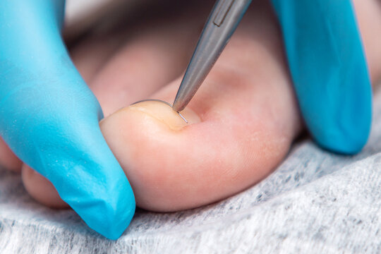 A podologist in blue gloves puts a titanium thread on a toenail. Close-up. The concept of podology and chiropody