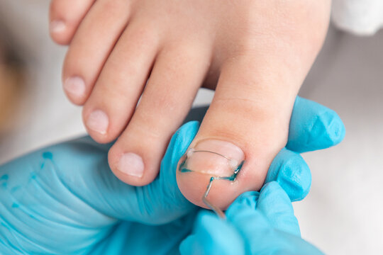 A podologist in blue gloves clean with curette a ingrown toenail. Close-up of nail with titanium thread. Top view. The concept of podology and chiropody