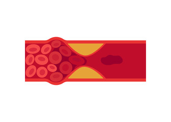 Blood clot, thrombus in vein or artery. Deep vein thrombosis DVT or arterial clot, artery and vein cholesterol sick, abnormally of blood vascular flow. Blocked circulation in blood vessel. Vector - obrazy, fototapety, plakaty